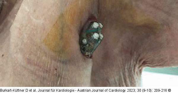 SM-Tascheninfektion -  Perforation