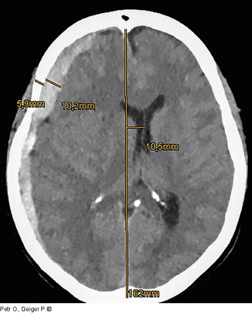 Akutes Subduralhämatom