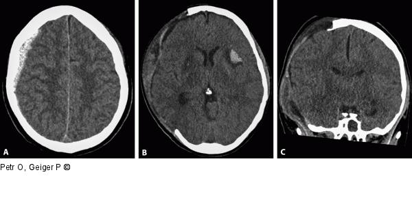 Akutes Subduralhämatom