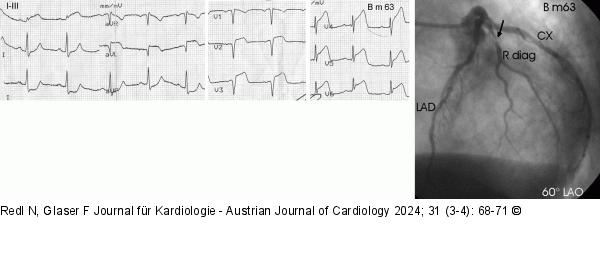 EKG - Angriographie
