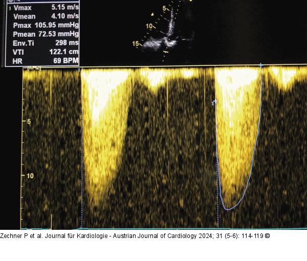 CW-Doppler - Overgain