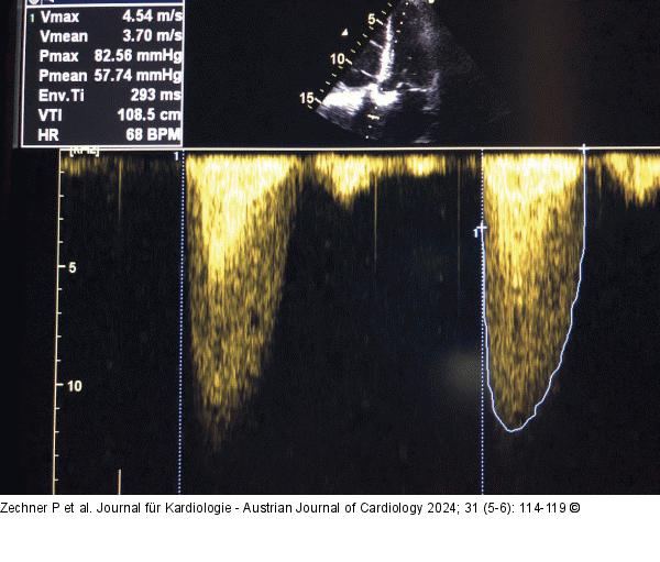 CW-Doppler - Overgain