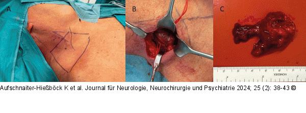 OP-Situs und Resektat