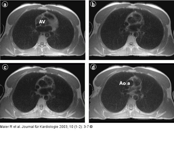 Kardiale Magnetresonanztomographie