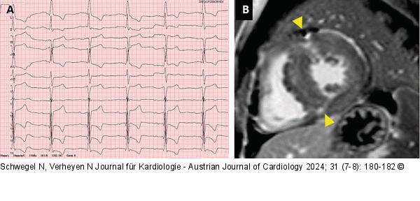 EKG-Veränderungen