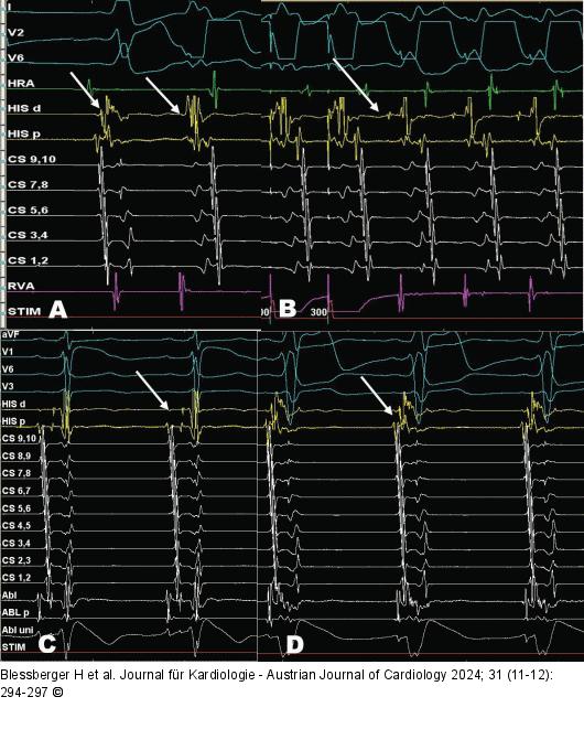 HRA-Katheter -  His-Katheter - CS-Katheter - RVA-Katheter
