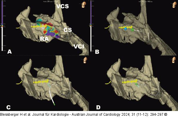 3D-Anatomie - Rechter Vorhof