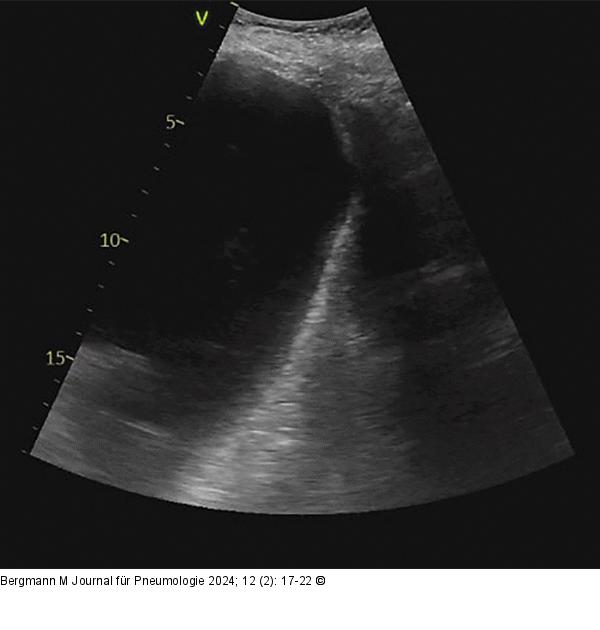 Abgeplattetes/invertiertes Zwerchfell
