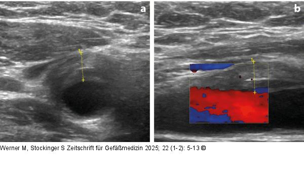Sonographie bei TIPIC-Syndrom