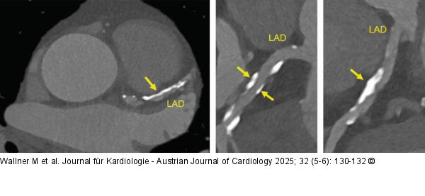 Coronary-CT