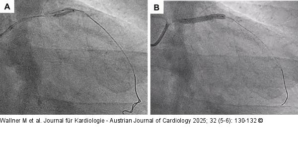 Buddy ballon technique