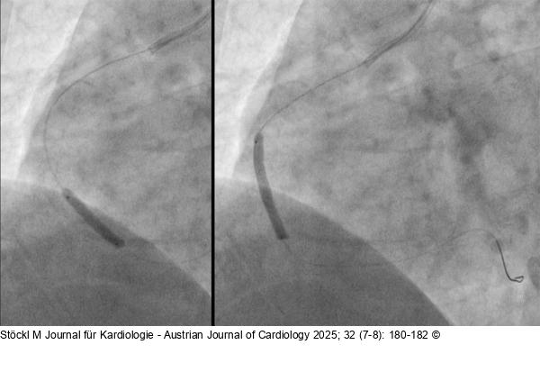 RCA: Drug Eluting Balloons