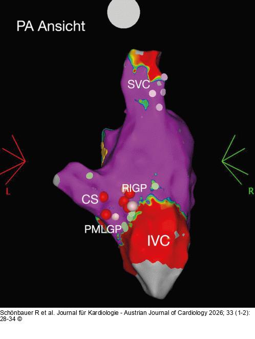 Elektroanatomisches Voltage-Mapping
