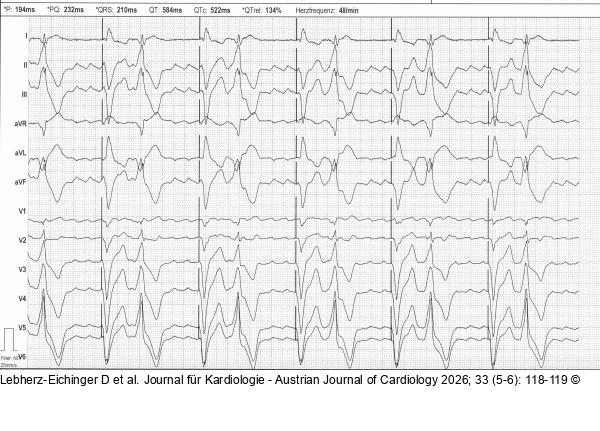 EKG