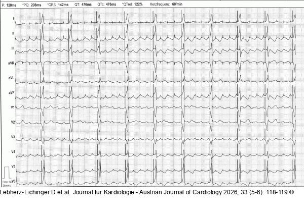 EKG