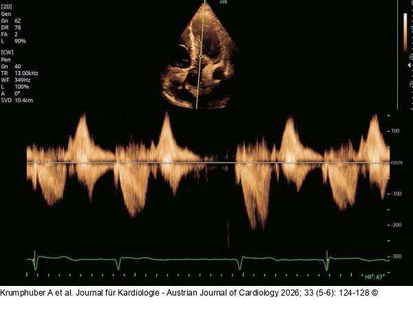 Fall 1: LVOT-Gradient