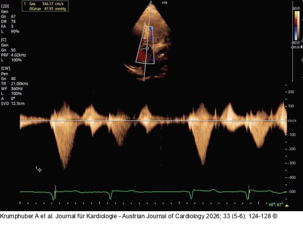 Fall 1: LVOT-Gradient