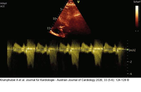 Fall 2: LVOT-Gradient