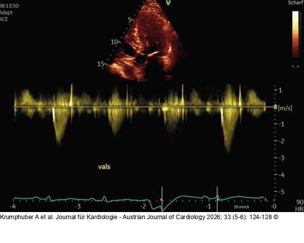 Fall 3: LVOT-Gradient