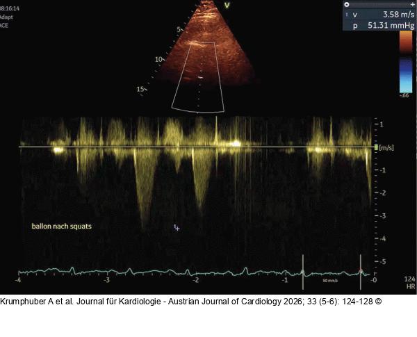 Fall 3: LVOT-Gradient