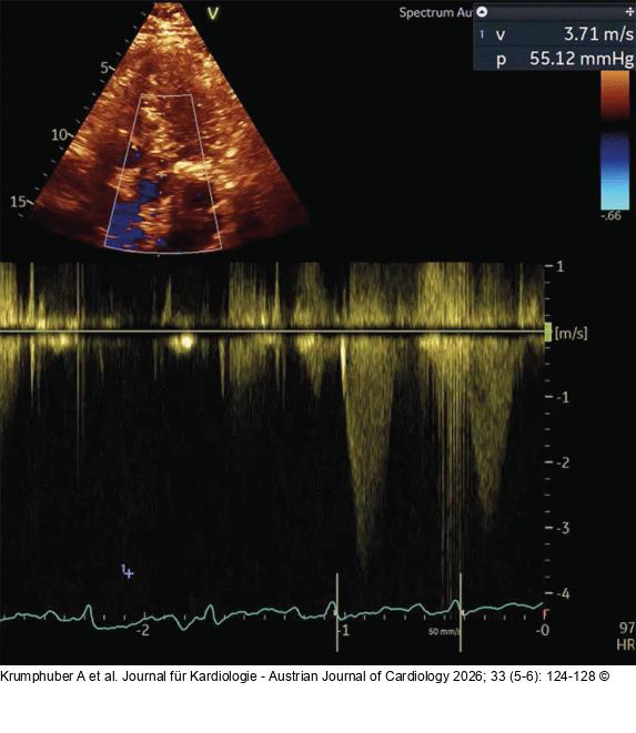 Fall 3: LVOT-Gradient