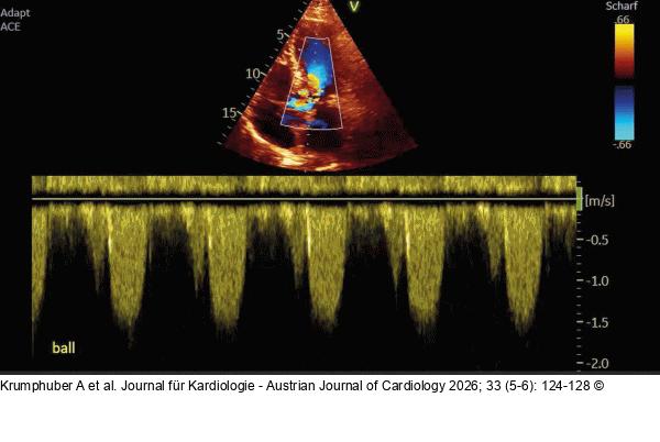 Fall 4: LVOT-Gradient