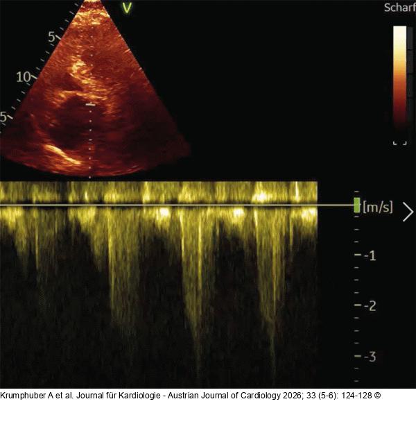 Fall 4: LVOT-Gradient