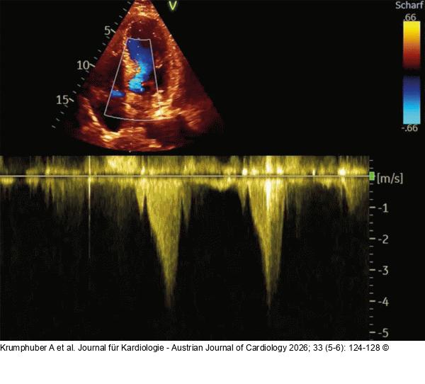Fall 4: LVOT-Gradient