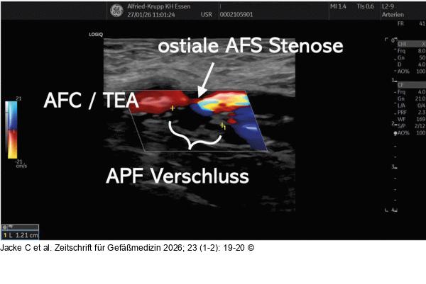 Duplexsonographie