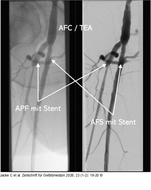 Kissing-Stent