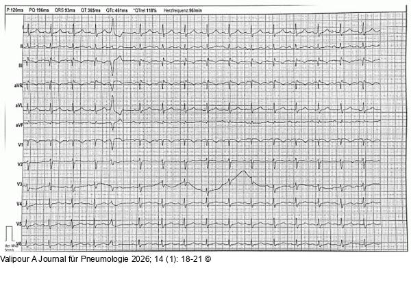 EKG