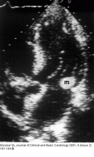 Endokarditis - Diagnose - TEE