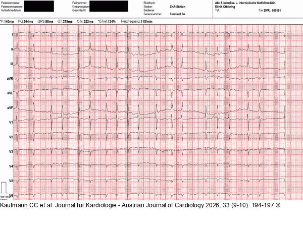 EKG