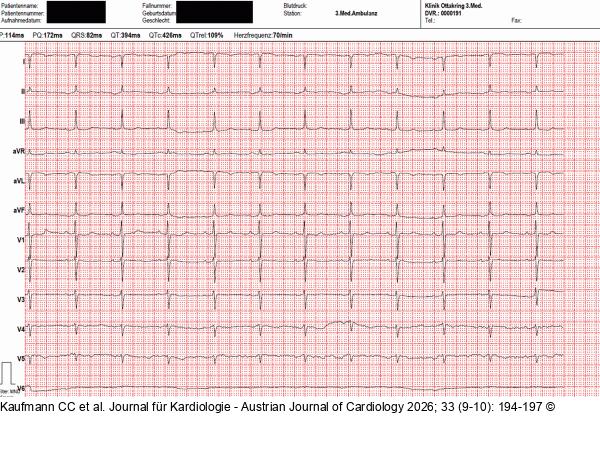 EKG