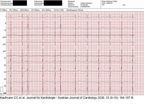 EKG