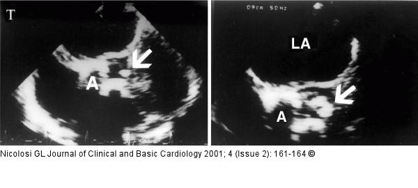 Endokarditis - Diagnose - TEE