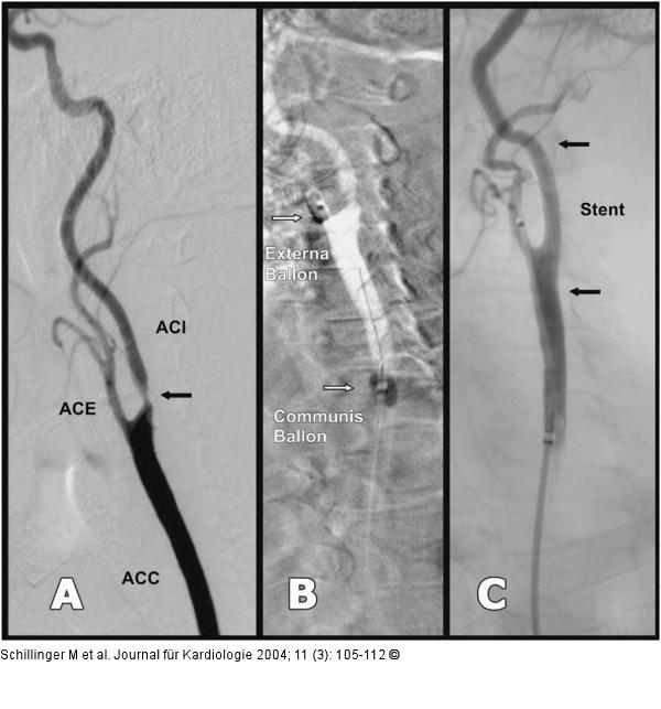 Karotisstenose - Stent