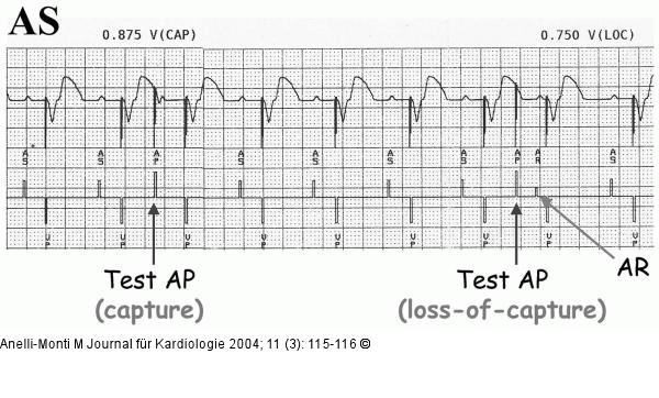 Schrittmacher - Atrial Chamber Reset