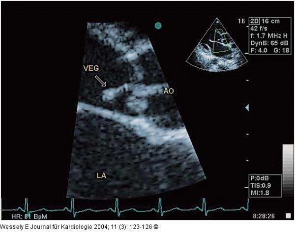 Aortenklappeninsuffizienz - Endokarditis