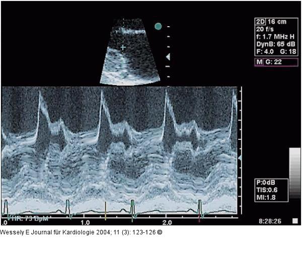 Aortenklappeninsuffizienz - Endokarditis