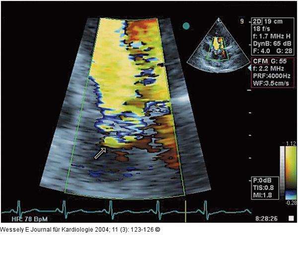 Aortenklappeninsuffizienz - Endokarditis