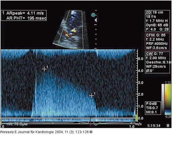 Aortenklappeninsuffizienz - Endokarditis