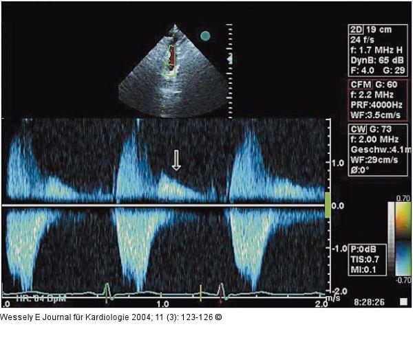 Aortenklappeninsuffizienz - Endokarditis