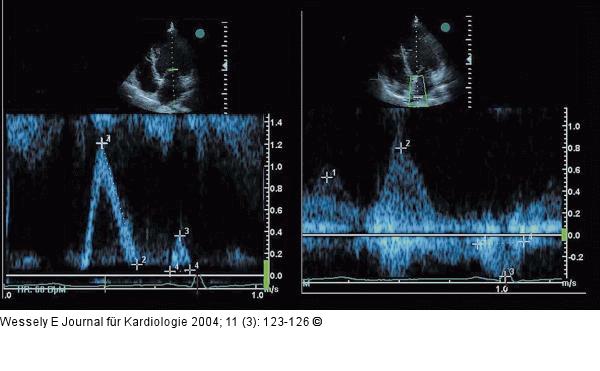 Aortenklappeninsuffizienz - Endokarditis