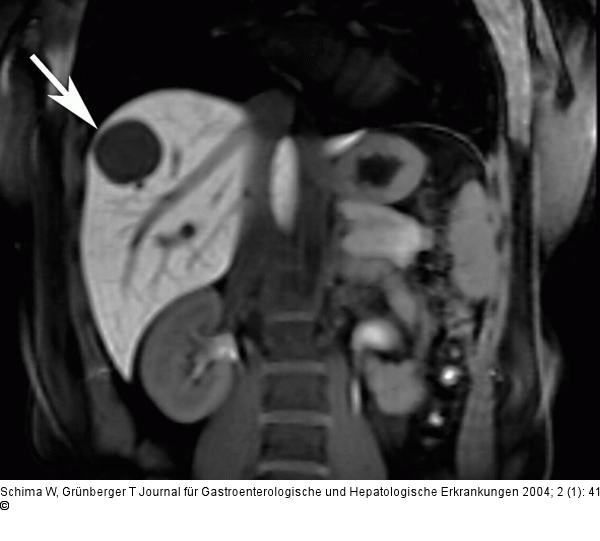 Echinokokkus - Leber