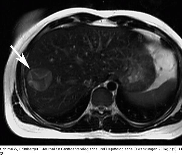Echinokokkus - Leber