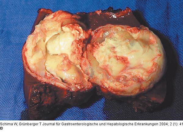 Echinokokkus - Leber