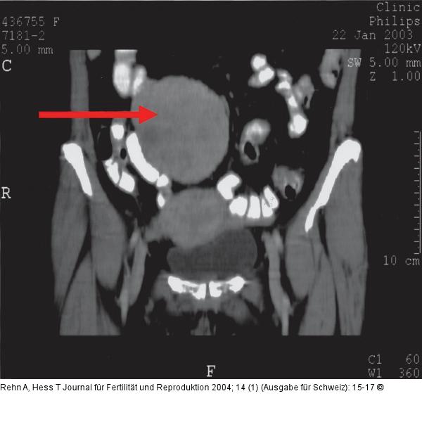 Leiomyomatöse Omentum majus-Neoplasie