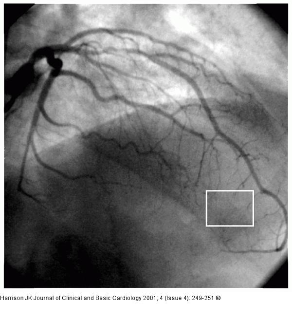 R. interventricularis anterior - Stenose