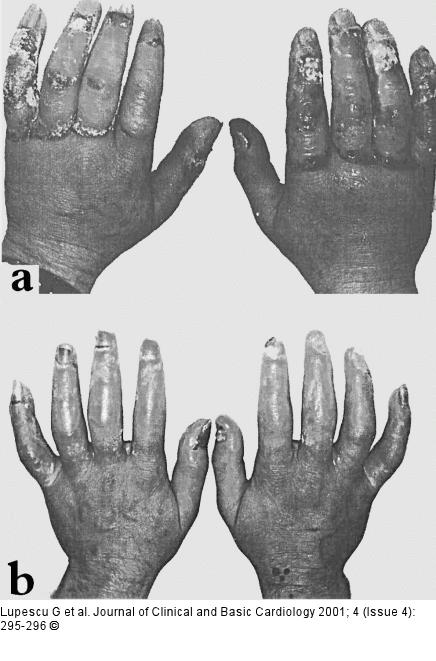 Nitroglyzerin transdermal